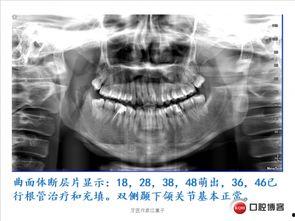 成人徒手拔牙视频过程图,图解操作步骤与注意事项
